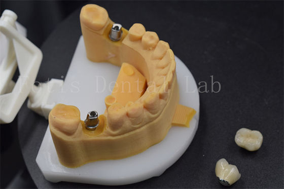 簡単に置くジルコニア 歯冠 歯用のチタン 冠 オーダーメイド