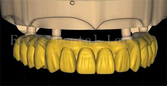 歯科王冠設計は 先進的なスキャンと3Dプリンティング技術を使用します